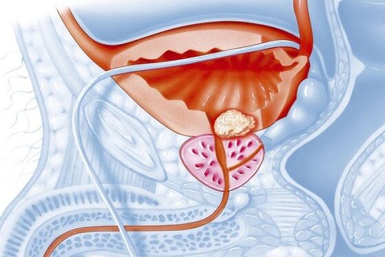 Inflammatory process in the prostate gland