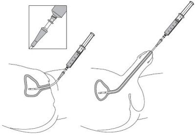 The encouragement of a drug solution in the urethra