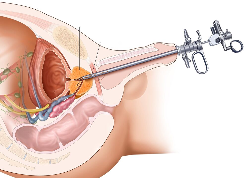 Transurethral resection of the prostate allows removing the affected parts of the organ