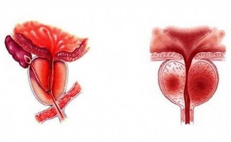 Acute inflammation of the prostate gland, which can be chronic