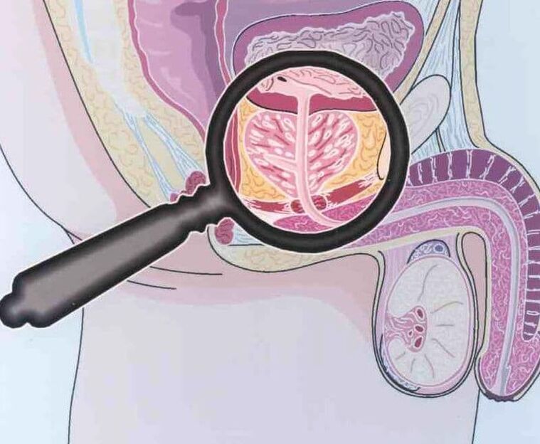 Defeat of prostate tissue in men with chronic prostatitis