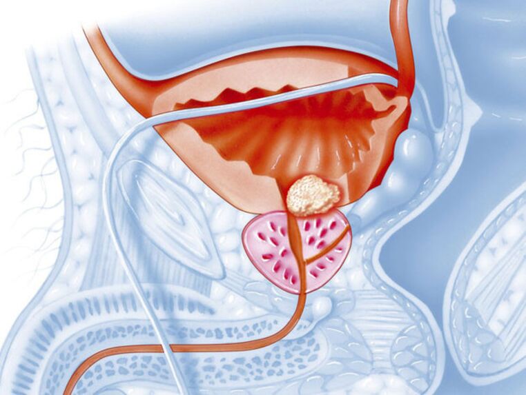 In chronic prostatitis, the lumen of the urethra narrows, which makes it difficult for urine to pass out. 